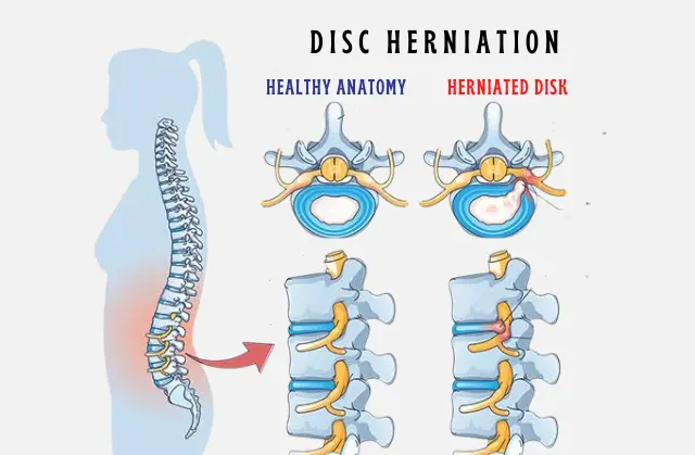Slipped Disc Treatment