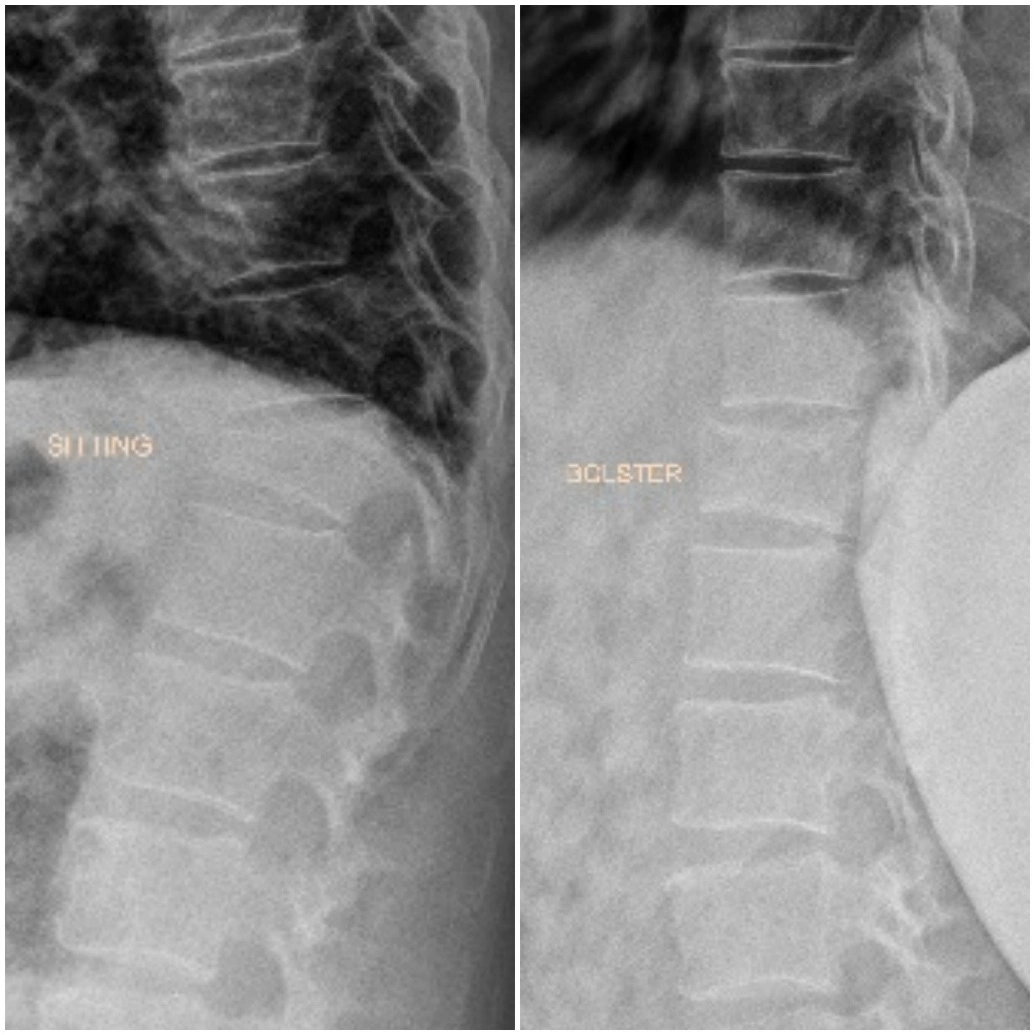 POVCF OSTEOPOROTIC