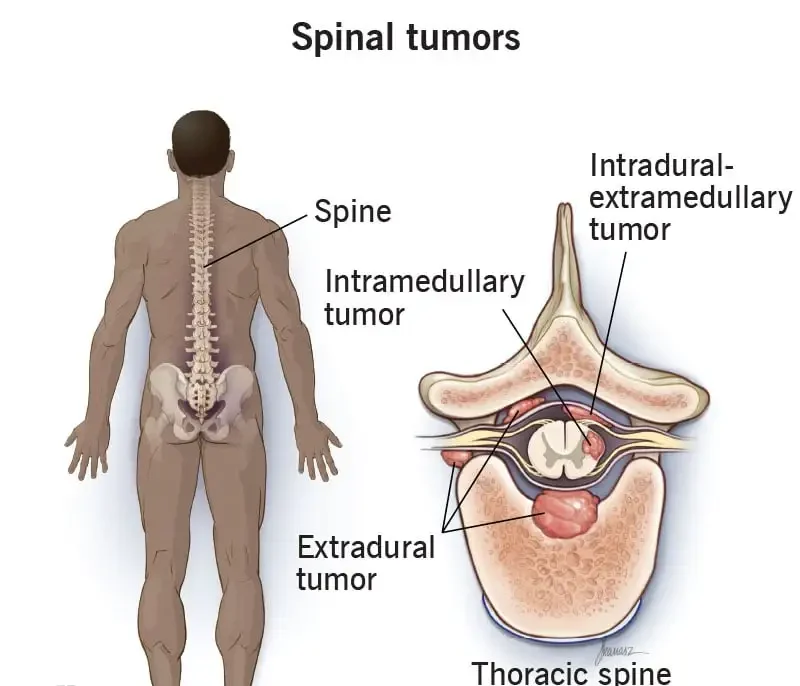 Spinal Tumors Treatment