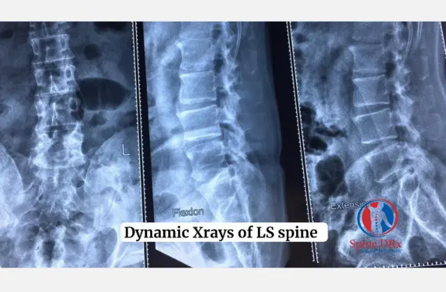 Successful TLIF Surgery of a Patient Aged 38 Years Male from Recurrent Disc Prolapse Nightmare