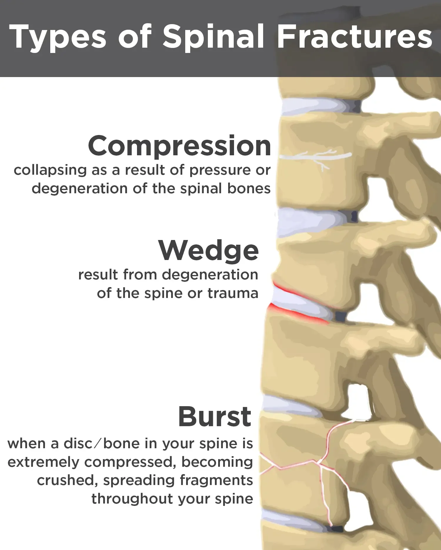 Spinal Fracture Treatment Bangalore