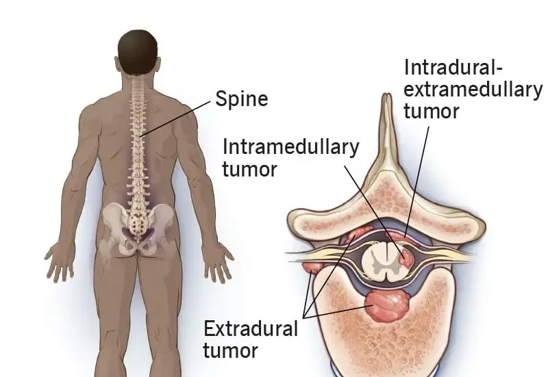 Spinal Tumors Treatment in Bangalore