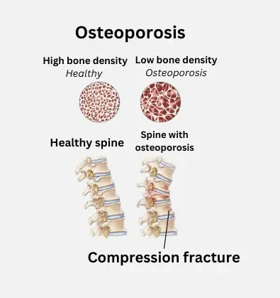 Osteoporotic Fractures Treatment Bangalore Osteoporotic Fractures Treatment Bangalore
