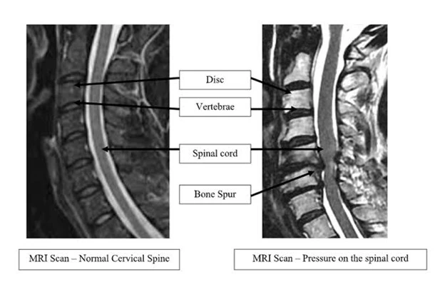 Cervical Myelopathy Treatment Bangalore Cervical Myelopathy Treatment Bangalore