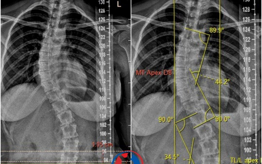 ‘Bringing back Curves as Smile’ in a 19 year Scoliosis girl