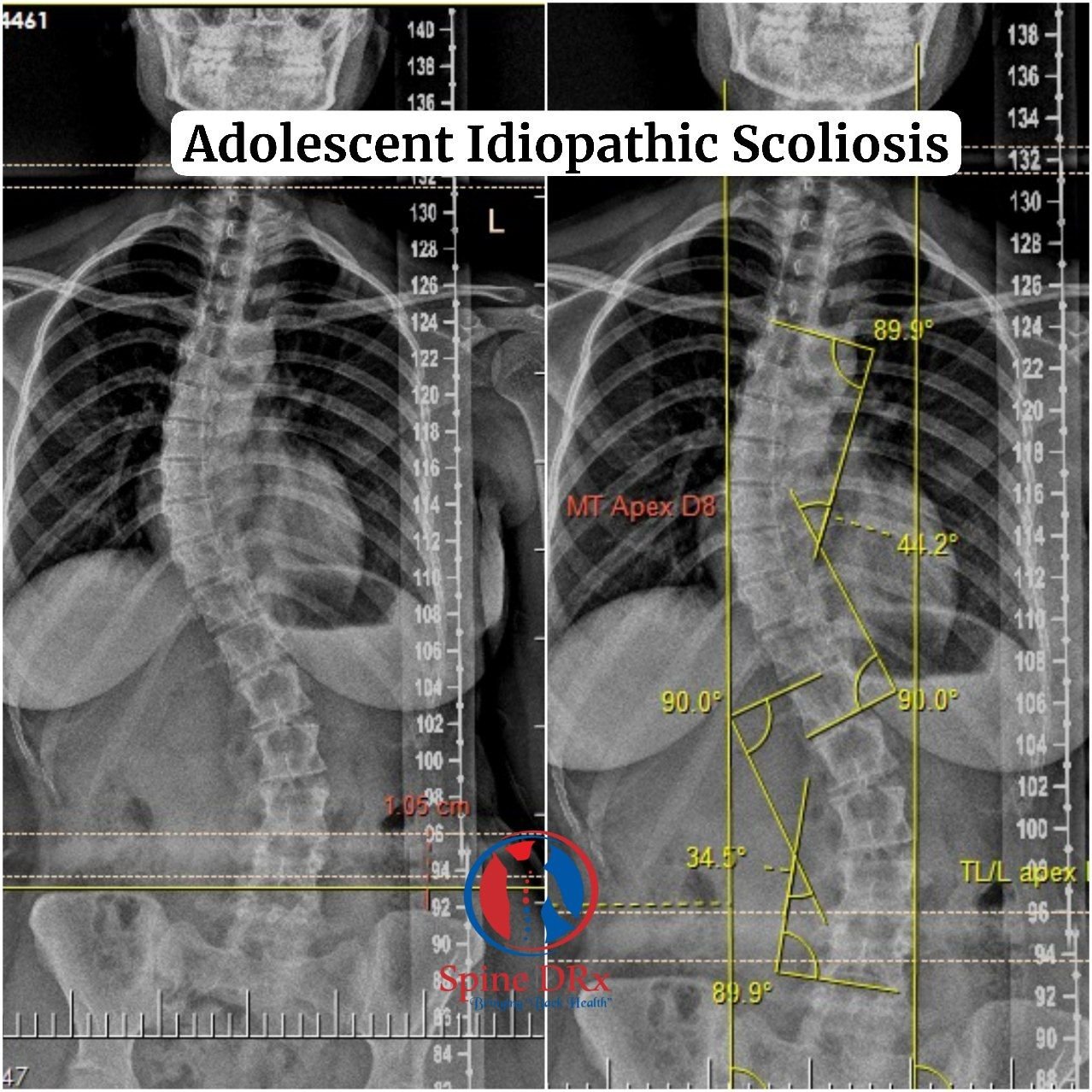 ‘Bringing back Curves as Smile’ in a 19 year Scoliosis girl