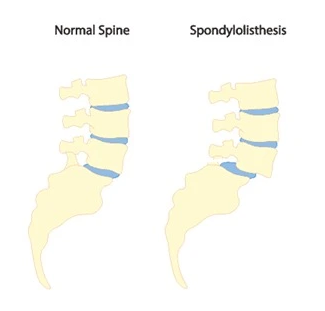 Lumbar Spondylolisthes Treatment Bangalore Lumbar Spondylolisthes Treatment Bangalore