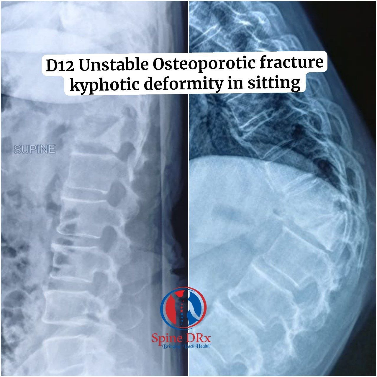 Neglected Osteoporotic Vertebral fracture