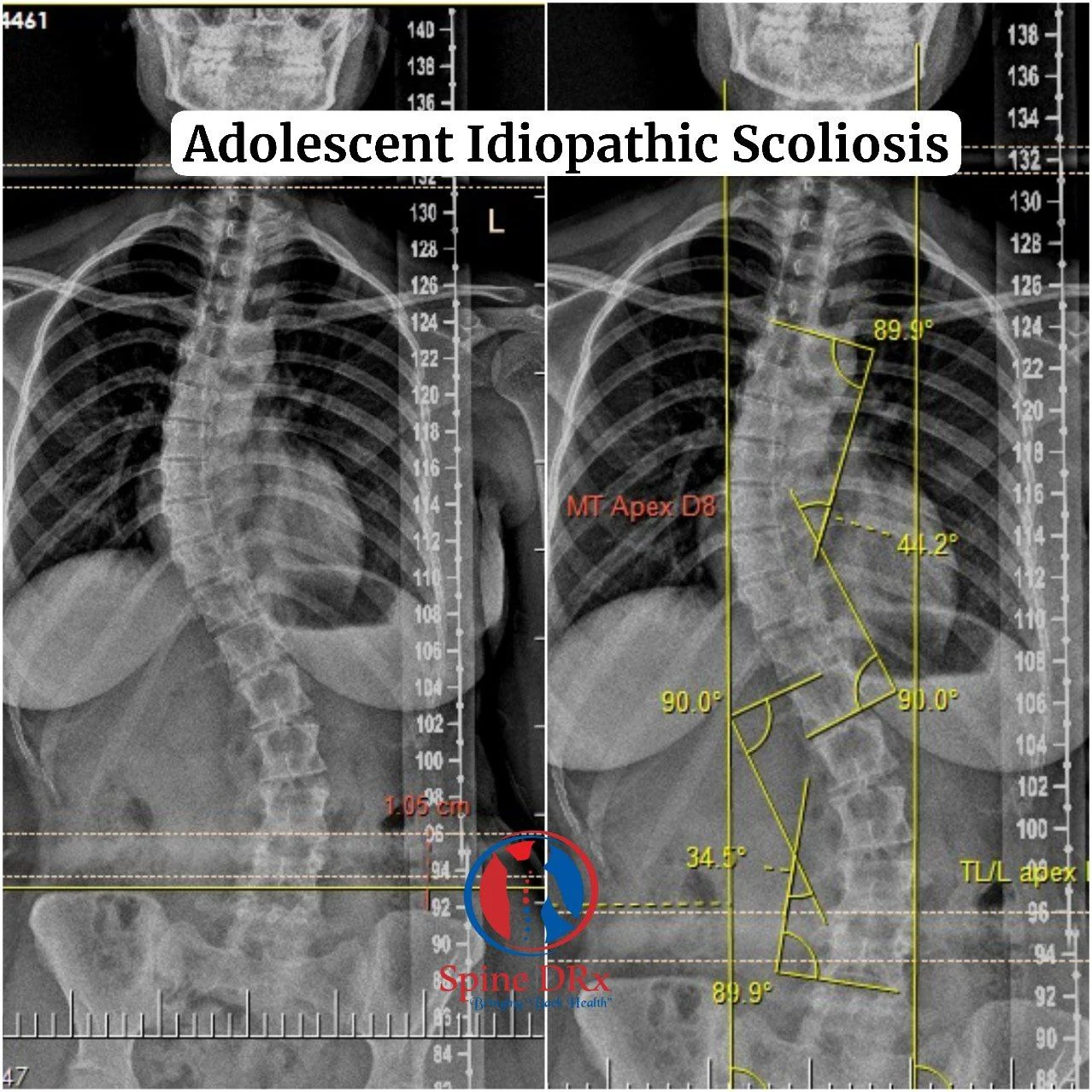 Adolescrnt Idiopathic Socliosis