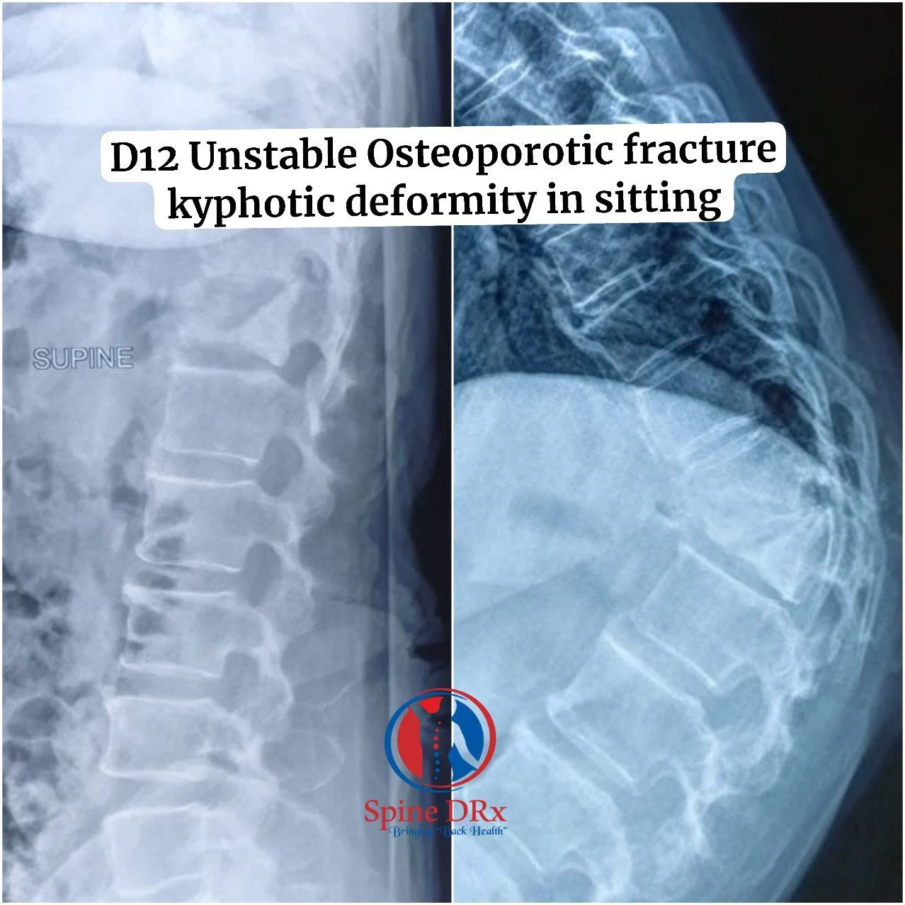 D12 Unstable Osteoporotic Fracture Keyphotic Deformity in Sitting