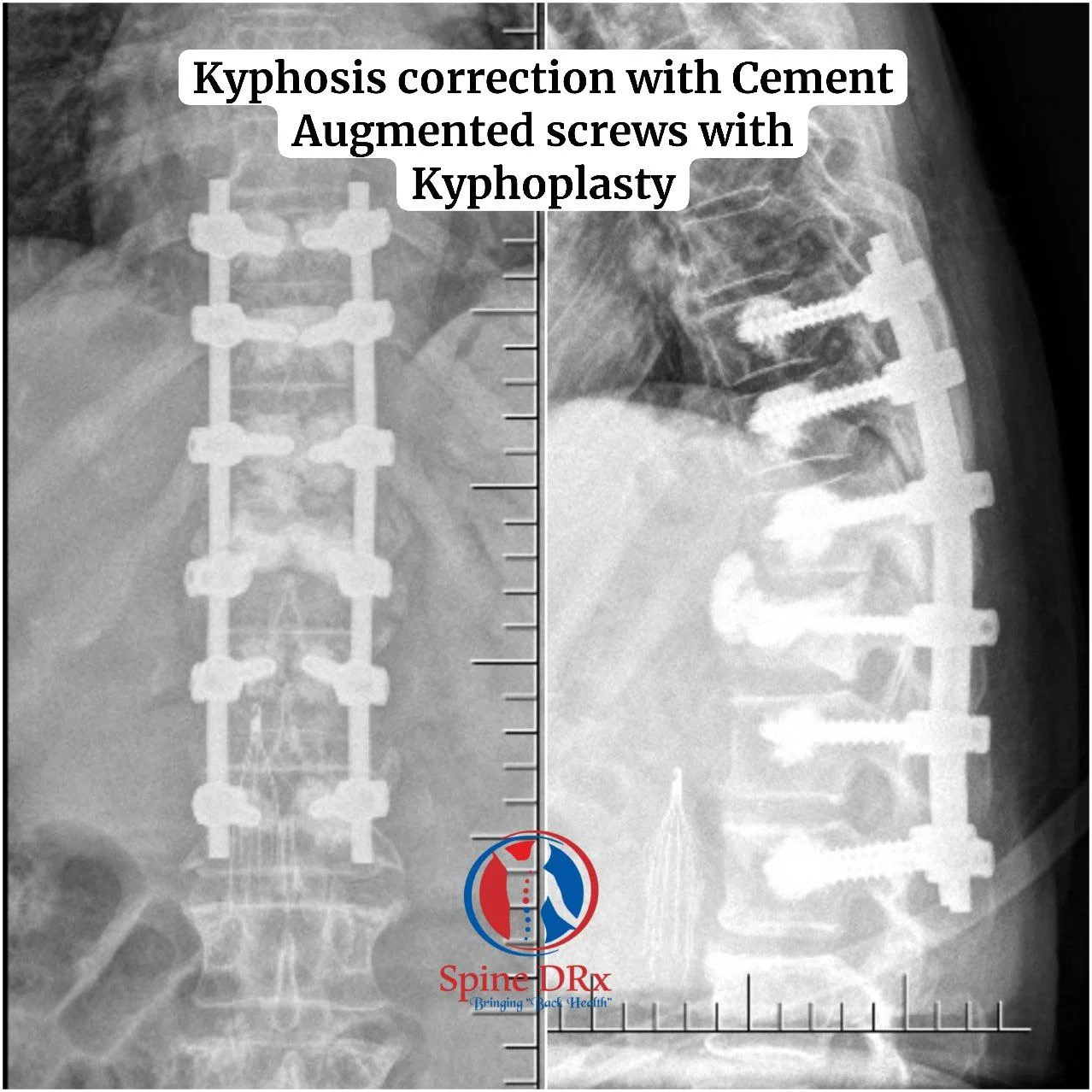 Kyphosis Correction with Cement Augmented Screws with Kyphoplasty