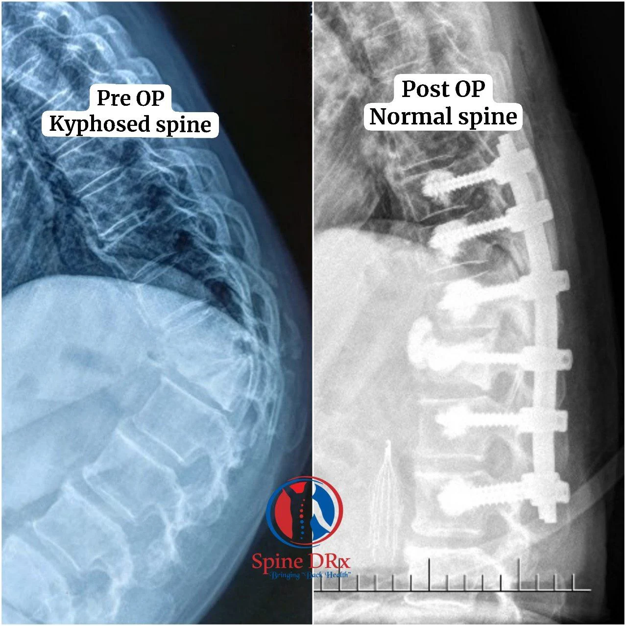 Prr OP & Post OP