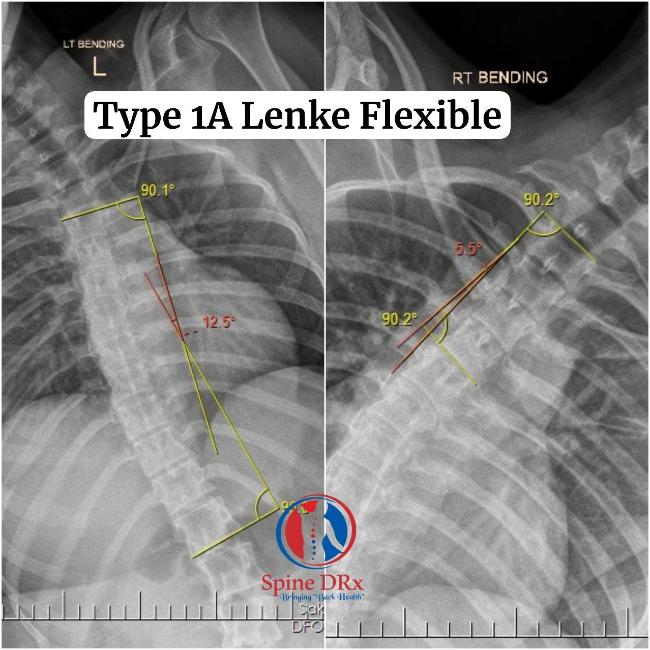 Type 1A Lenke Fexible