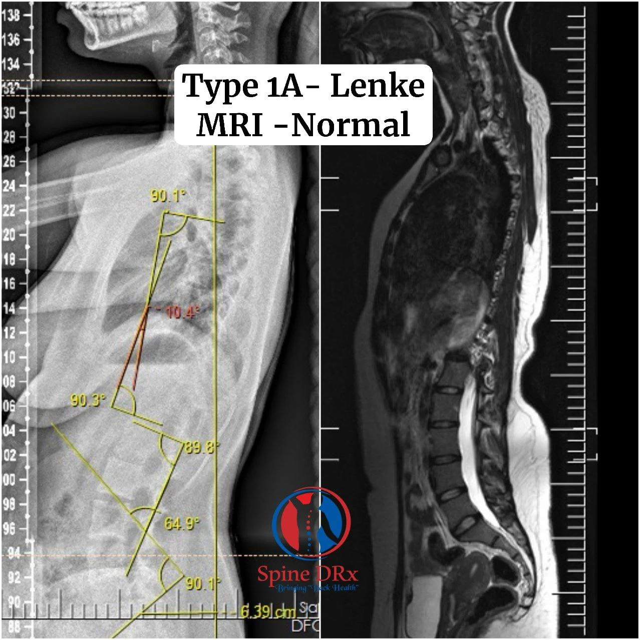 Type 1A Lenke MRI - Normal