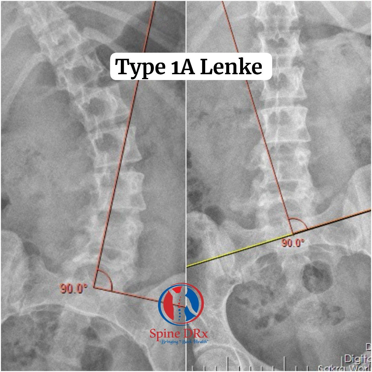 Type 1A Lenke