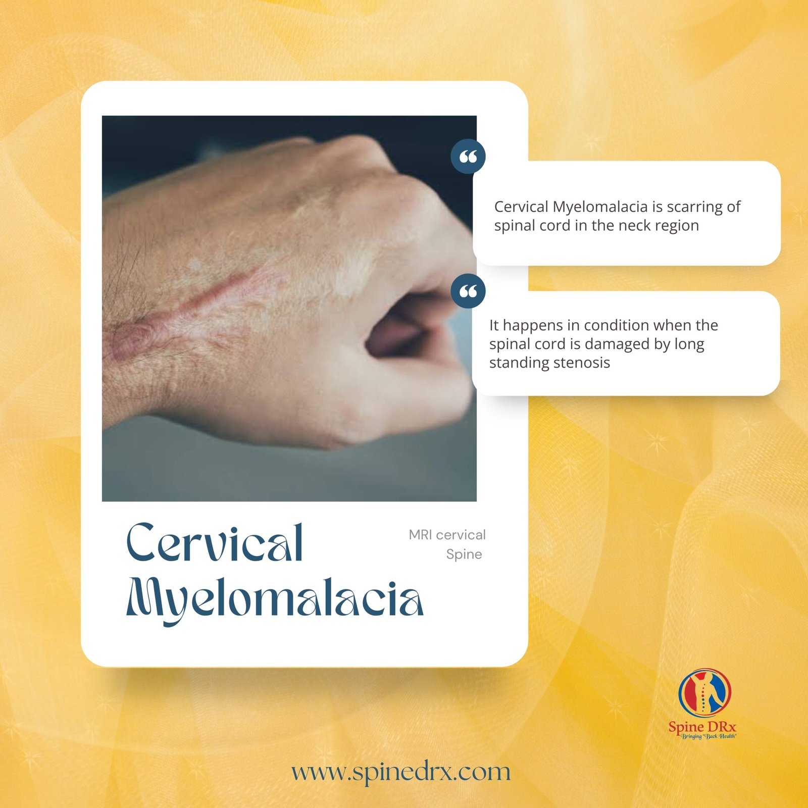 Spine & Spinal cord scarring