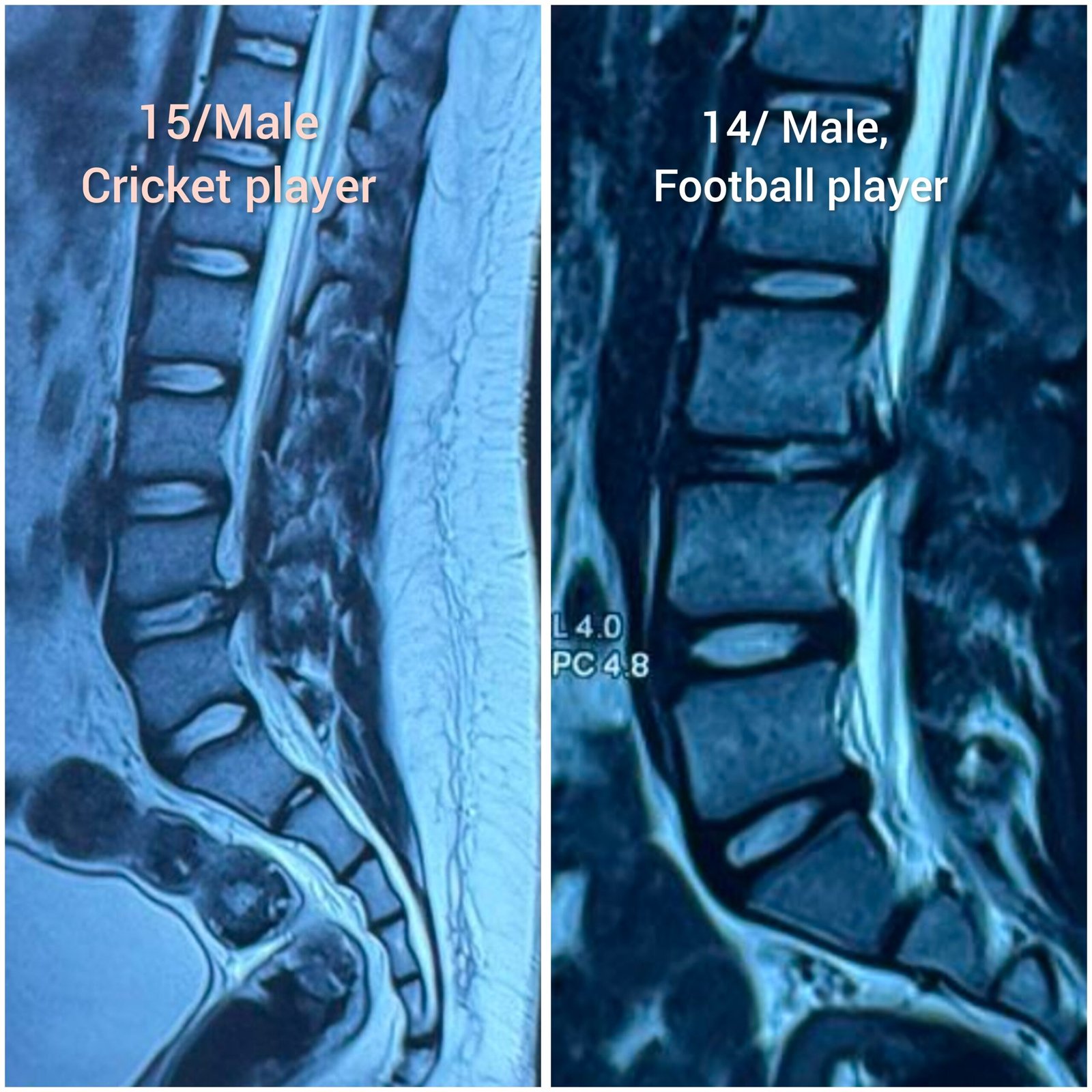 Teenage Disc Prolapse – A Hidden Threat in Young Athletes