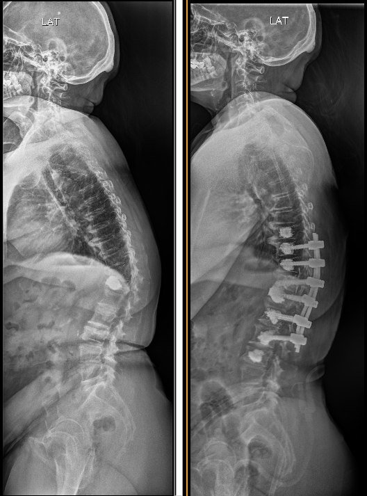 Osteoporotic Spine Fracture in a 65-Year-Old – A Case of Recovery Through Holistic Spine Care