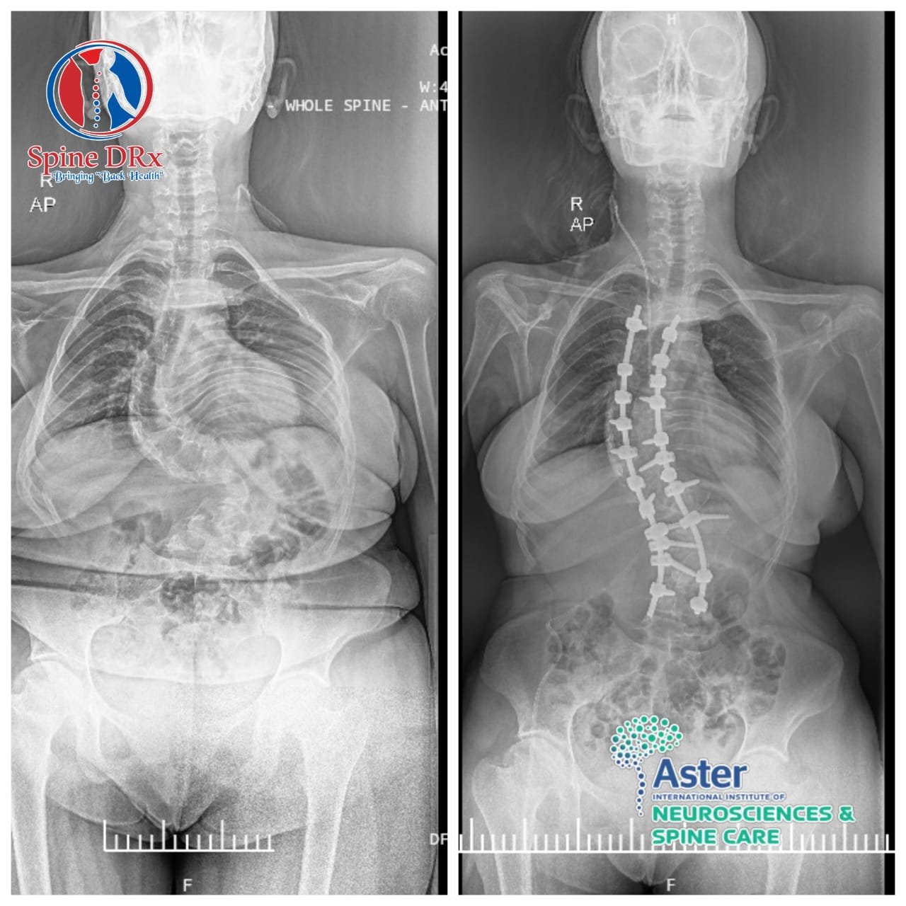 From Fear to Walking: A Remarkable Recovery