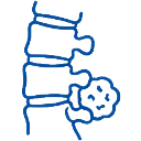 Spinal Tumors Vertebral tumor diagnosis image