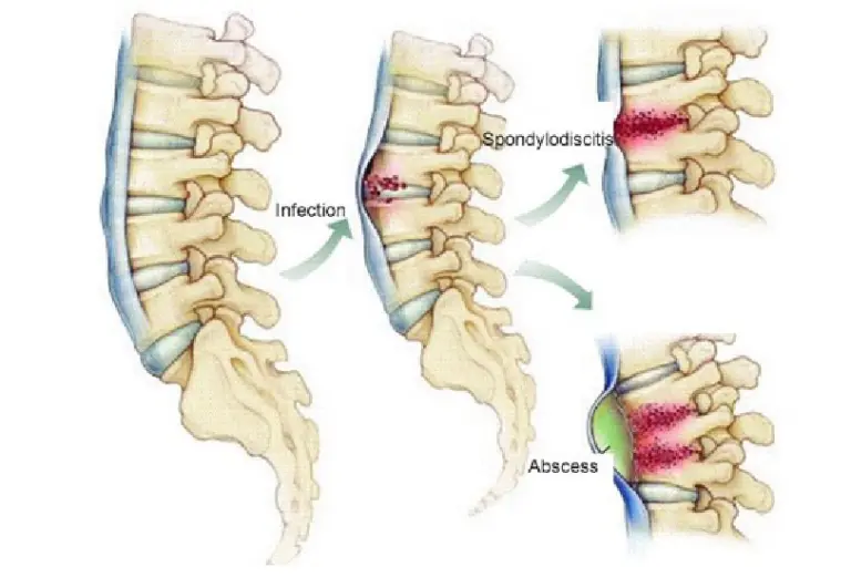 Spondylodiscitis-T-A