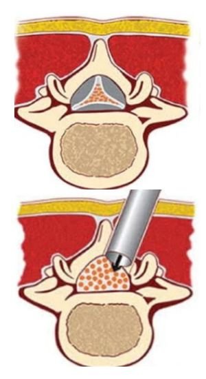 Lumbar Spine decompression Surgery Bangalore
