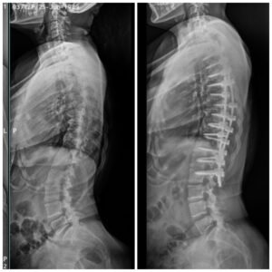 Robotic Scoliosis Surgery Xray