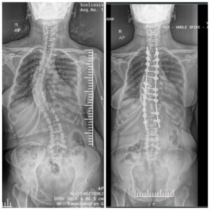 Robotic Scoliosis Surgery xray 1
