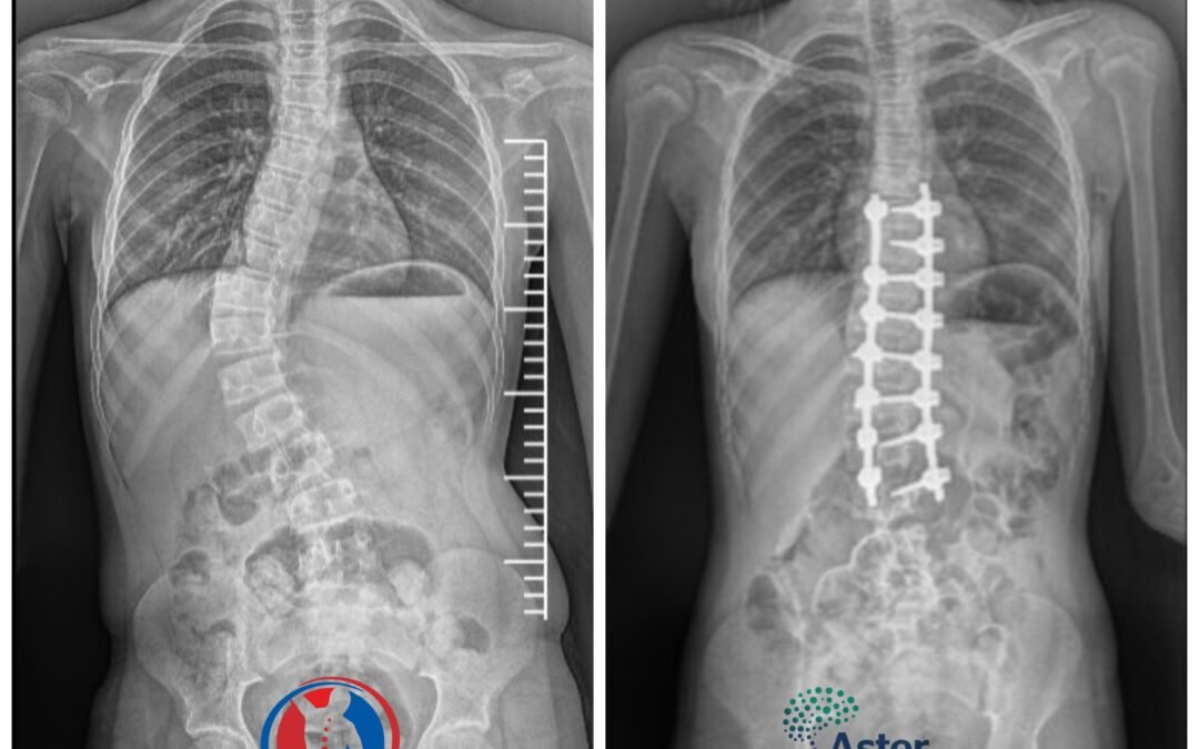 Successful Robotic Scoliosis Correction in a 12-Year-Old Girl