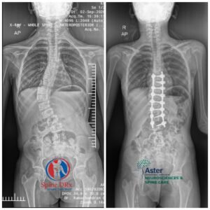 scoliosis-robotic-spine-surgery