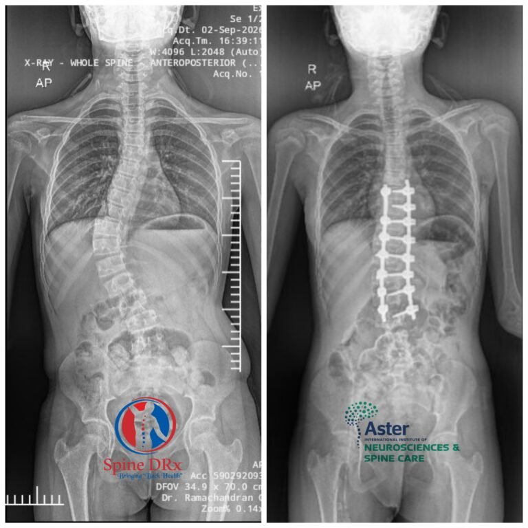scoliosis-robotic-spine-surgery