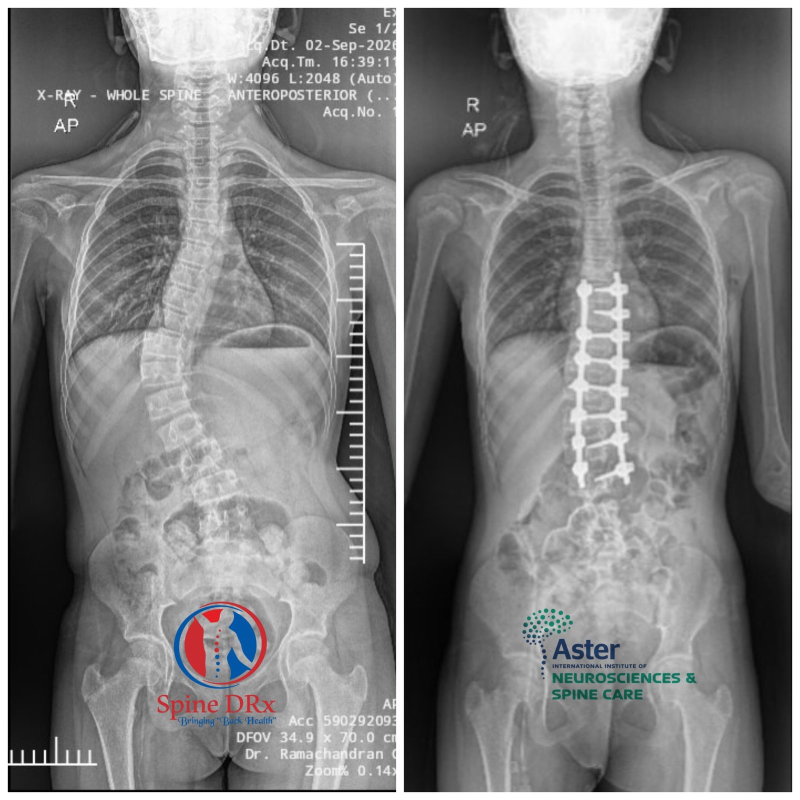 scoliosis-robotic-spine-surgery